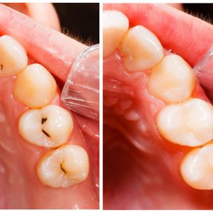 White-Fillings-Composite-300x300